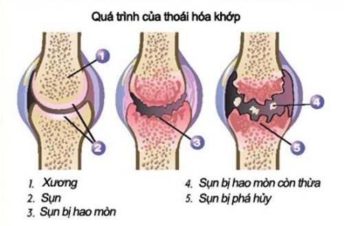 bệnh xương khớp là gì