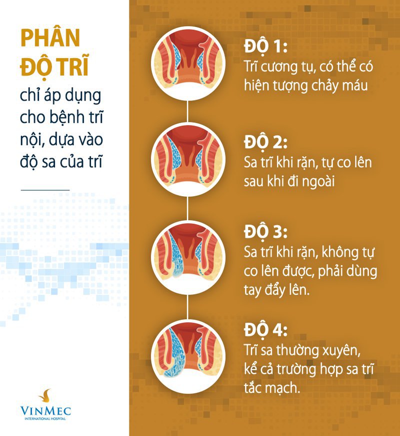 Trĩ ngoại