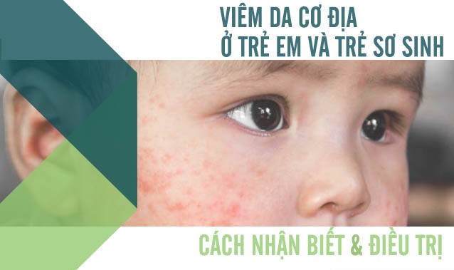 Viêm da cơ địa ở trẻ em